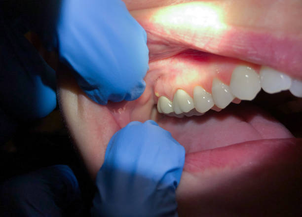 Best Dentist for Tooth Abscess  in Homerville, GA